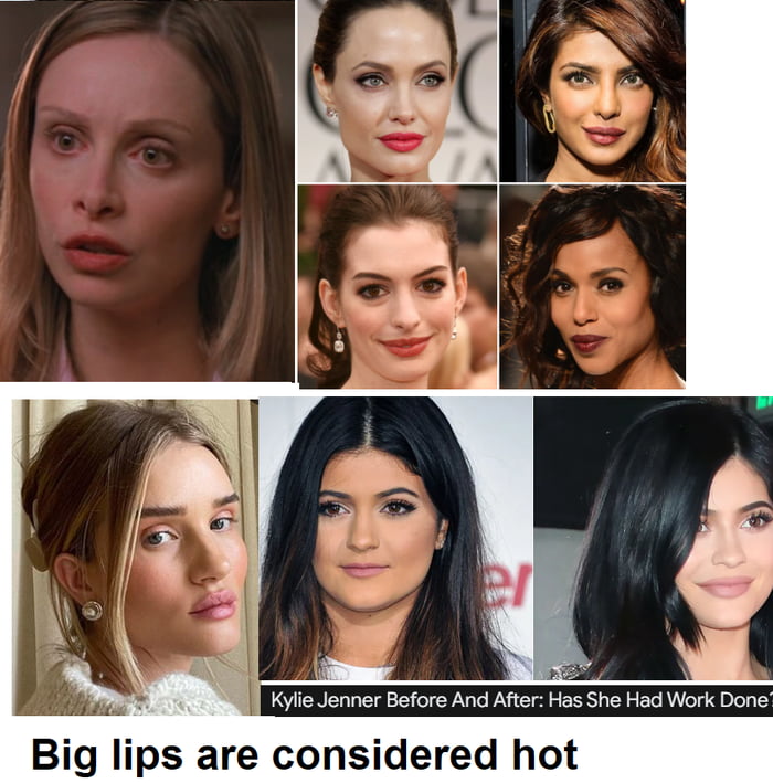 Lip fillers are a popular type of dermal filler. They're inj