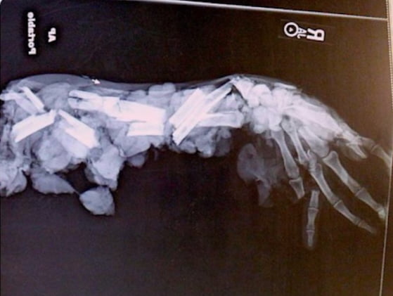 X-ray of a hand after a meat grinder accident..in case you t