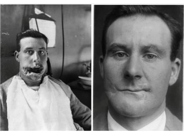 In 1916 Charles Dicks suffered injuries as a soldier. Him be Image